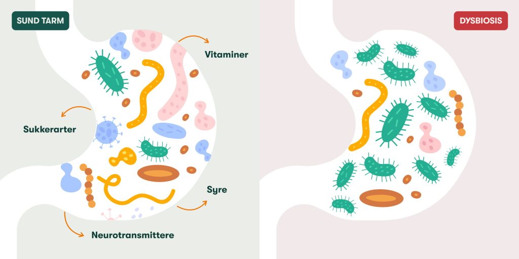 Sammenligning af sund tarm og dysbiose: varieret mikrobiota med vitaminer og neurotransmittere vs bakteriedominans