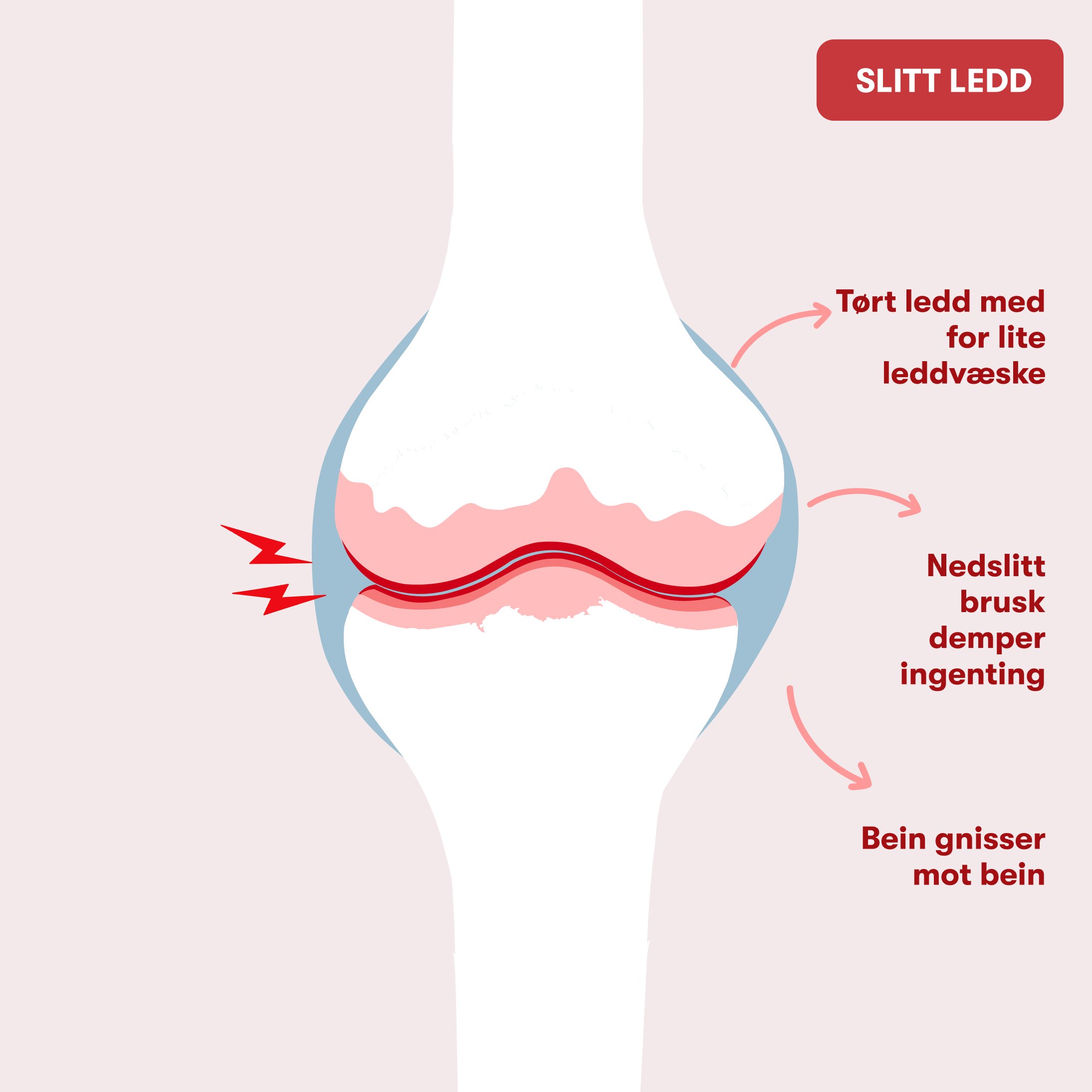 Diagram af knæled med nedslidt brusk, reduceret ledvæske og røde smerteindikatorer